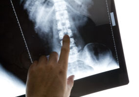 spinal injuries